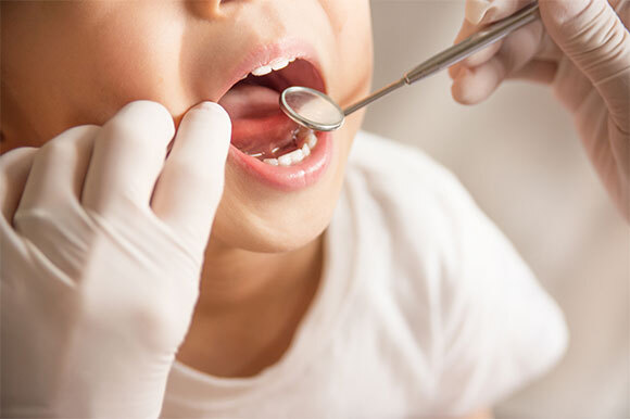 虫歯の予防方法